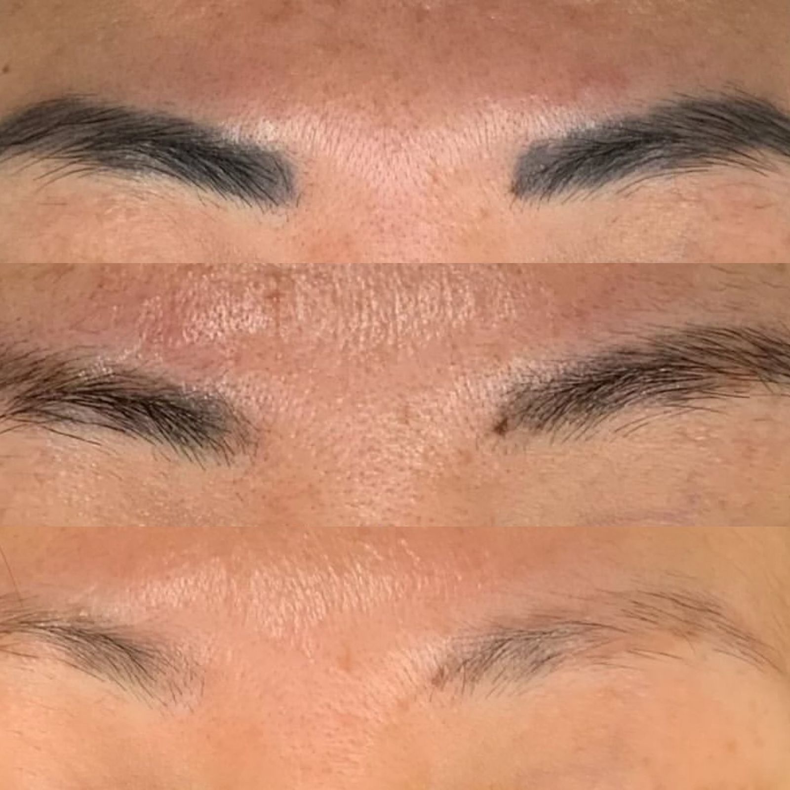 Resultado de remoção a laser